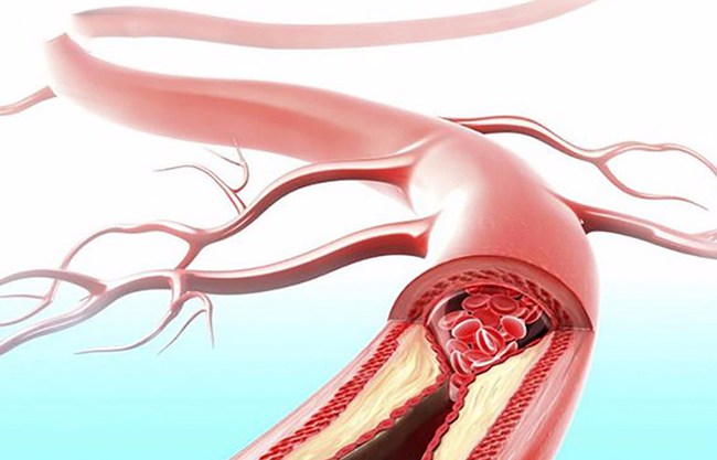 Mạch máu tắc nghẽn là nguyên nhân hàng đầu dẫn đến đột tử (Ảnh minh họa)
