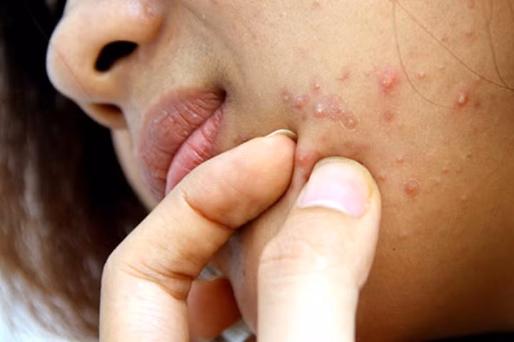 5 việc làm hủy hoại da, chỉ cần một đêm là khiến da xấu đi trông thấy!