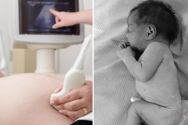 Không siêu âm thai, mẹ "chết lặng" khi đẻ con có 4 chân, 2 bộ phận sinh dục