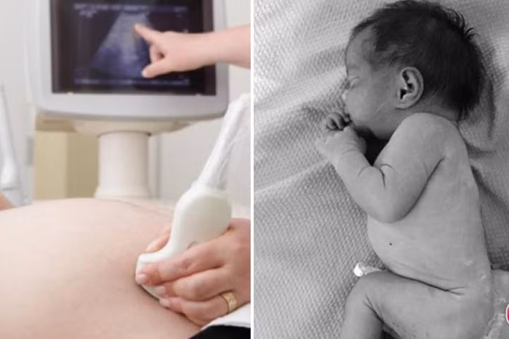 Không siêu âm thai, mẹ "chết lặng" khi đẻ con có 4 chân, 2 bộ phận sinh dục