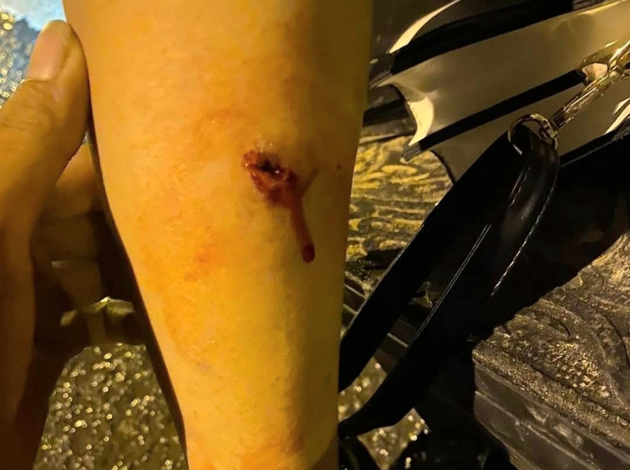 Vết thương trên chân chị Q. do trúng đạn.