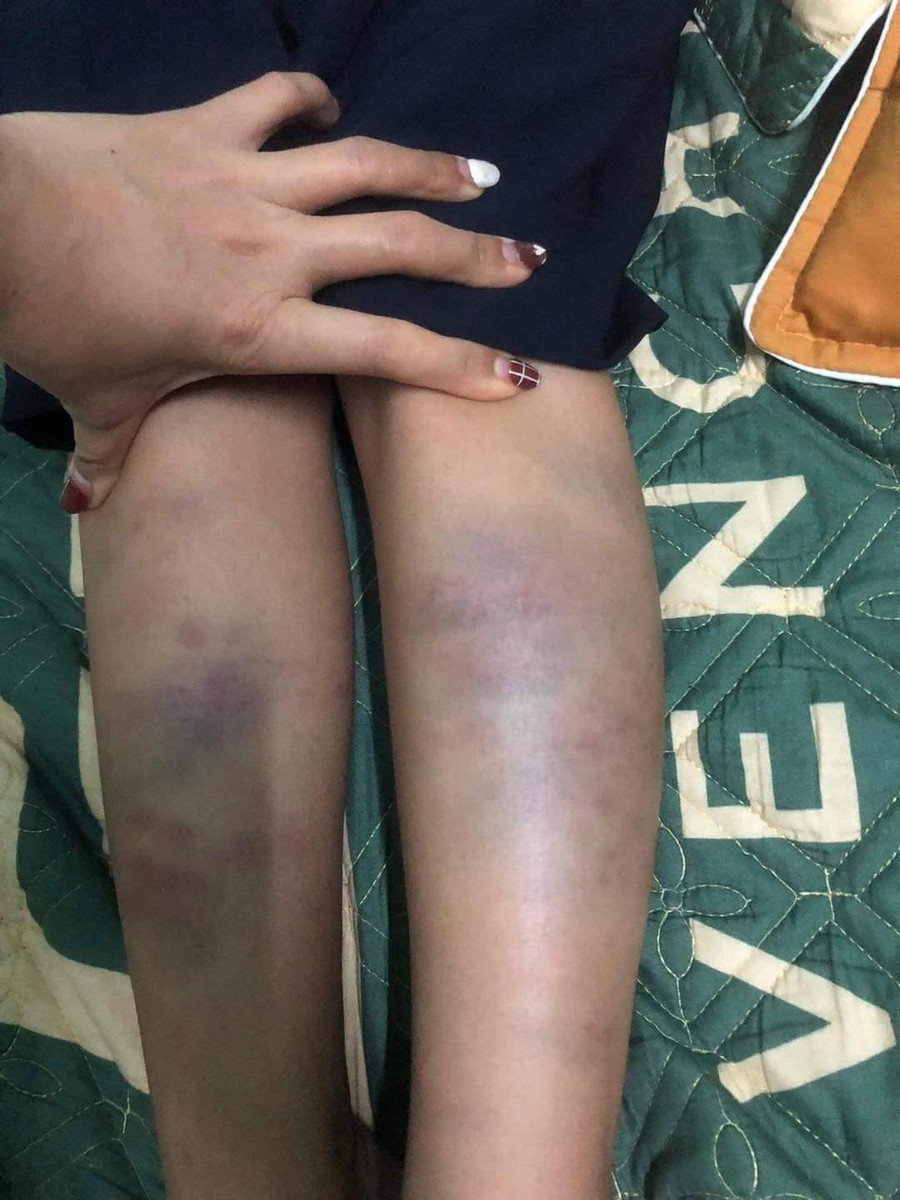 Rất nhiều vết bầm trên cẳng tay và chân của em N.H.T.H. được gia đình chụp lại để trao đổi với cô giáo chủ nhiệm. Cô giáo chỉ thông báo sự việc khi phụ huynh nhắn tin hỏi nguyên nhân các vết bầm tím trên cơ thể của con sau khi tan trường. Rất nhiều vết bầm trên cẳng tay và chân của em N.H.T.H. được gia đình chụp lại để trao đổi với cô giáo chủ nhiệm. Cô giáo chỉ thông báo sự việc khi phụ huynh nhắn tin hỏi nguyên nhân các vết bầm tím trên cơ thể của con sau khi tan trường.