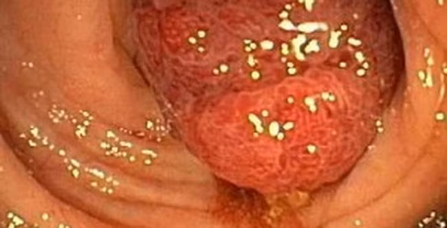 Ngủ dưới 6h mỗi đêm tăng 50 % nguy cơ bị bệnh polyp ruột già so với ngủ ít nhất 7h mỗi đêm. Polyp nếu không điều trị có thể chuyển thành ung thư.