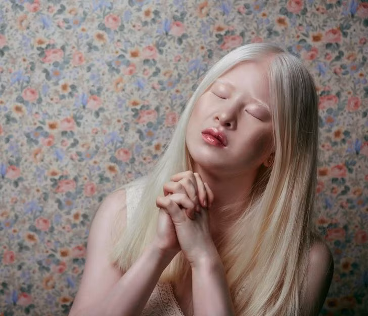 Từ đứa trẻ mắc bệnh bạch tạng bị bỏ rơi đến siêu mẫu Vogue nổi tiếng ảnh 4