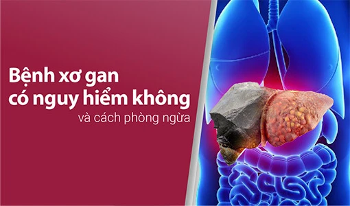 Tìm hiểu liệu rằng "Bệnh xơ gan có nguy hiểm không?"