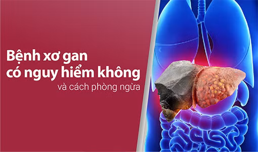 Tìm hiểu liệu rằng "Bệnh xơ gan có nguy hiểm không?"