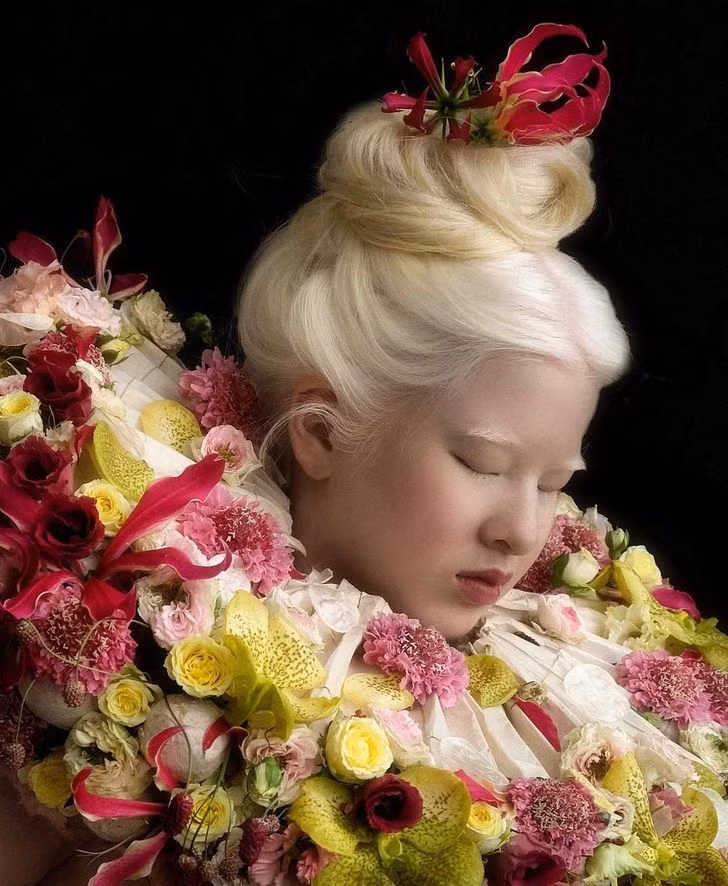 Từ đứa trẻ mắc bệnh bạch tạng bị bỏ rơi đến siêu mẫu Vogue nổi tiếng ảnh 5