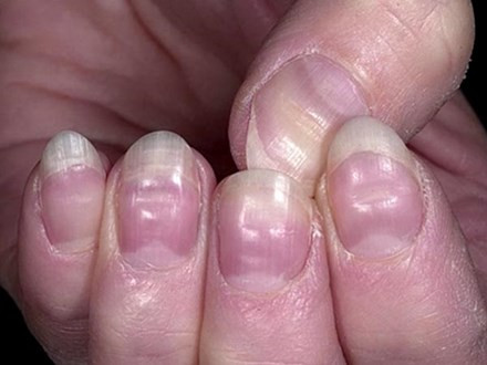 Móng tay cảnh báo bệnh tật