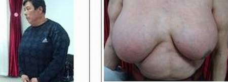 Vú to ở nam giới