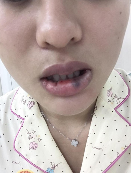 Tiêm môi trái tim bị biến dạng, cô gái đi phẫu thuật lấy ra 18 cục to tròn - Ảnh 2 Tiem moi trai tim bi bien dang, co gai di phau thuat lay ra 18 cuc to tron - Anh 2
