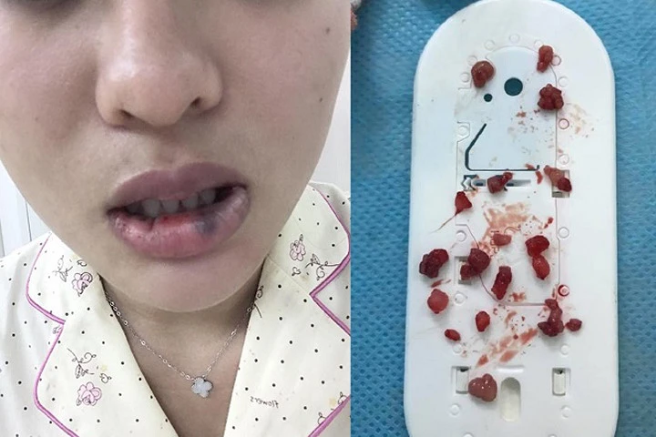 Tiêm môi trái tim bị biến dạng, cô gái đi phẫu thuật lấy ra 18 cục to tròn