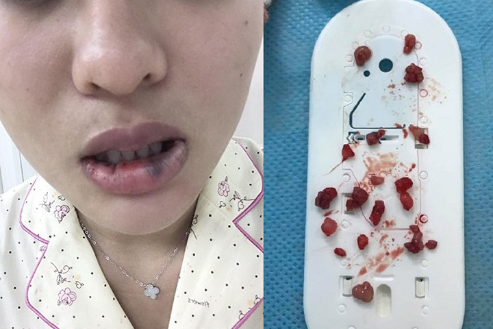 Tiêm môi trái tim bị biến dạng, cô gái đi phẫu thuật lấy ra 18 cục to tròn