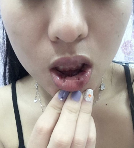 Tiêm môi trái tim bị biến dạng, cô gái đi phẫu thuật lấy ra 18 cục to tròn - Ảnh 4 Tiem moi trai tim bi bien dang, co gai di phau thuat lay ra 18 cuc to tron - Anh 4