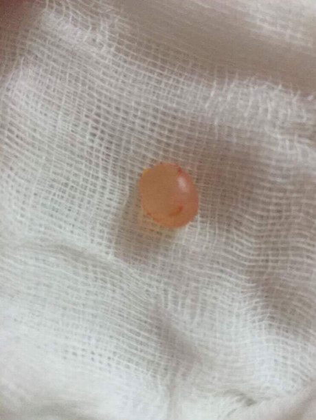 Tiêm môi trái tim bị biến dạng, cô gái đi phẫu thuật lấy ra 18 cục to tròn - Ảnh 6 Tiem moi trai tim bi bien dang, co gai di phau thuat lay ra 18 cuc to tron - Anh 6