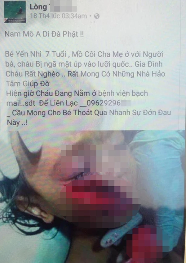 “Ngã ngửa” sự thật thông tin về em bé mồ côi cha mẹ, ngã vào lưỡi cuốc bị thương nghiêm trọng