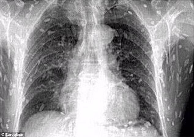 Phim chụp X-quang cho thấy sán dây làm tổ trong khắp cơ thể người đàn ông.