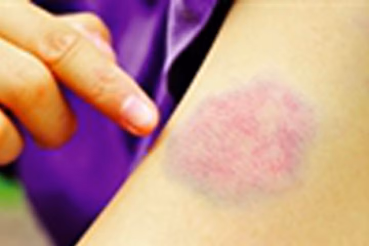 Những cách đơn giản trị vết bầm tím trên cơ thể