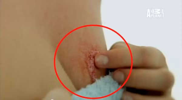 Giun móc chui vào cơ thể cô Allen qua vết mèo cào. Mô tả ảnh.