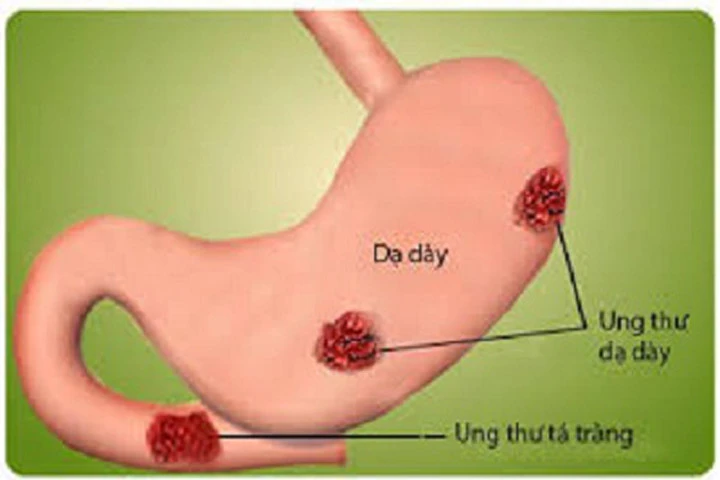 Cách phát hiện sớm ung thư đường tiêu hóa