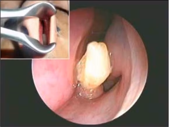 moc rang trong mui, cau be co 323 cai rang, so luong rang nhieu nhat the gioi, rang mọc trong nao, rang ma ca rong