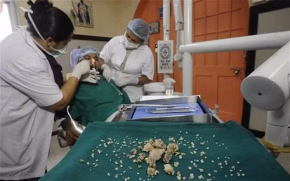 moc rang trong mui, cau be co 323 cai rang, so luong rang nhieu nhat the gioi, rang mọc trong nao, rang ma ca rong