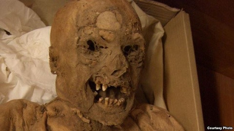 Những xác ướp từ thế kỉ 18 tiết lộ đầu mối về căn bệnh ung thư