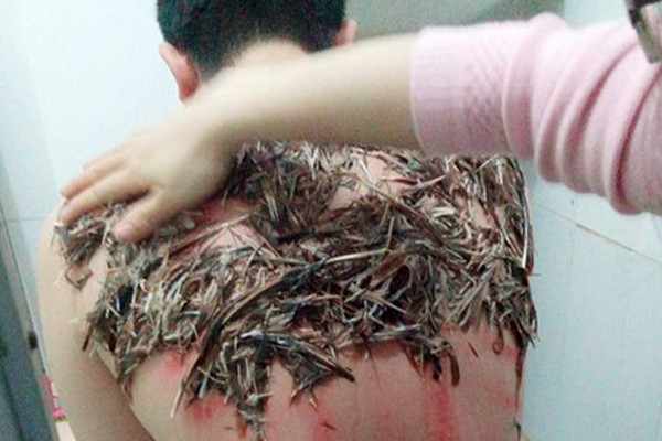 Nguy hiểm khôn lường khi dùng lông trộn tiết gà trị bệnh đậu Lào