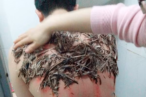 Nguy hiểm khôn lường khi dùng lông trộn tiết gà trị bệnh đậu Lào