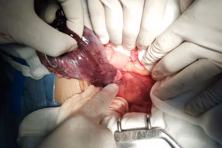 Cứu sống ca bệnh hi hữu 92 tuổi bị u nang xoắn buồng trứng