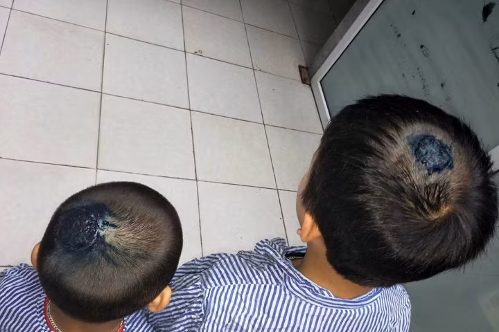 Chơi với chó mèo, 2 cháu bé bị lây bệnh nấm đầu