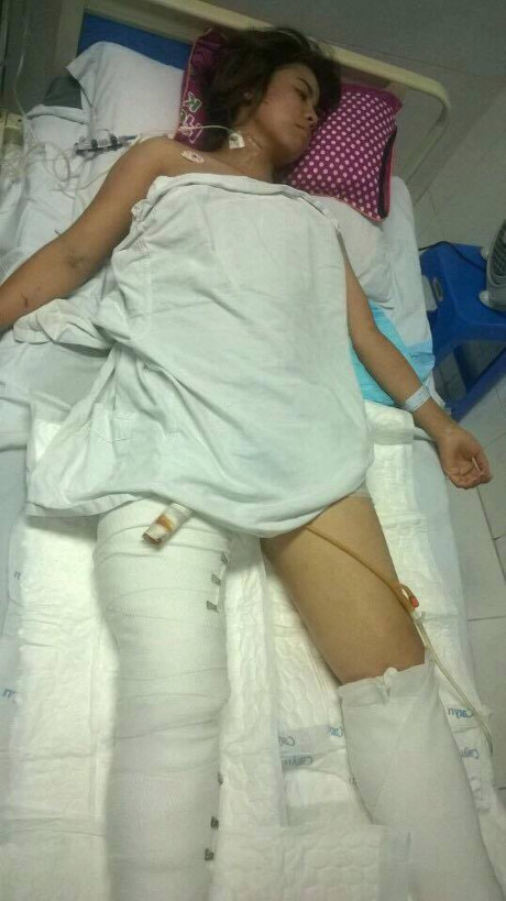Nạn nhân vụ sập nhà phố Cửa Bắc nguy cơ bị cưa chân - Ảnh 1 Nan nhan vu sap nha pho Cua Bac nguy co bi cua chan - Anh 1