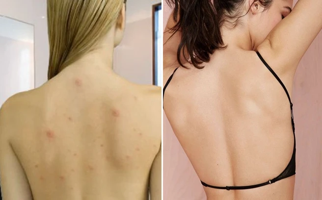 3 cách trị mụn ở lưng đơn giản nhất mà không phải ai cũng biết