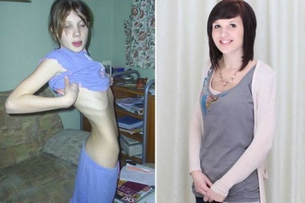 cô gái mắc chứng biếng ăn lột xác từ cô gái mắc chứng biếng ăn lột xác từ