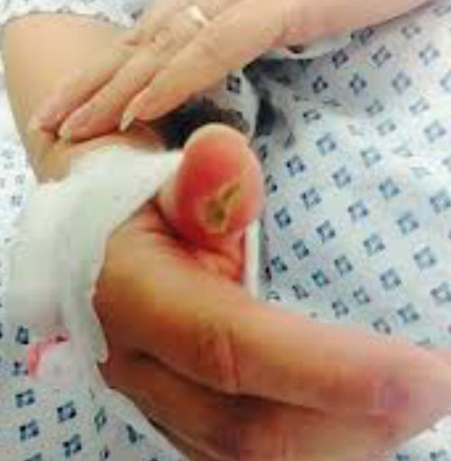 Bị hoại tử ngón tay chỉ vì coi thường điện giật - Ảnh 1