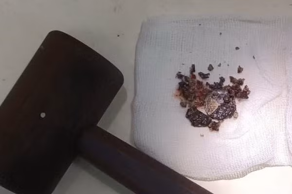 Đồng xu kim loại được lấy ra từ mũi của người đàn ông.