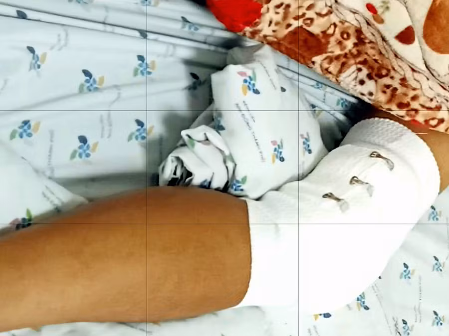 Chân của Tiến đã trải qua 3 lần phẫu thuật để điều trị.