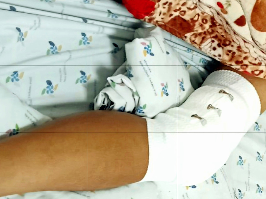 Chân của Tiến đã trải qua 3 lần phẫu thuật để điều trị. Chân của Tiến đã trải qua 3 lần phẫu thuật để điều trị.