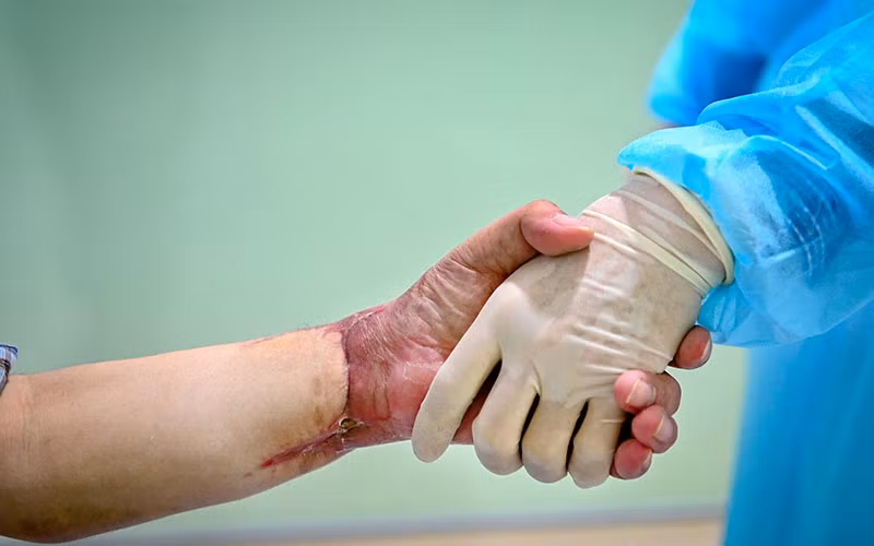 Cuộc sống mới của người đàn ông Việt Nam đầu tiên được ghép tay