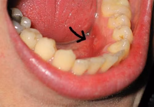 Thực phẩm cần kiêng khi bị nhiệt miệng nếu không muốn bị nặng hơn