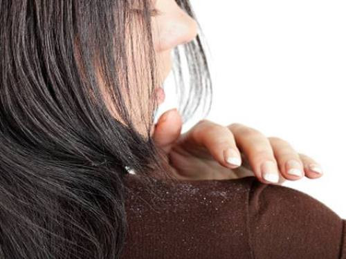 Điều gì xảy ra khi bạn bị gàu?