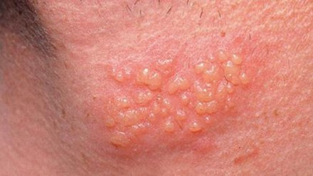 5 bài thuốc tự nhiên chữa mụn rộp tại nhà