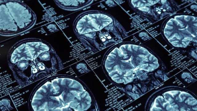 Ly do nam gioi mac ung thu nhieu hon nu gioi hinh anh 2 why_men_are_more_likely_to_die_of_brain_cancer_than_women_313441.jpg