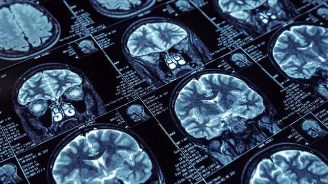 Ly do nam gioi mac ung thu nhieu hon nu gioi hinh anh 2 why_men_are_more_likely_to_die_of_brain_cancer_than_women_313441.jpg