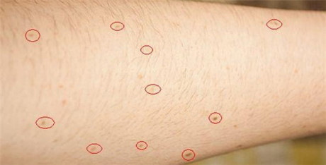 Vì sao nói những người có hơn 11 nốt ruồi trên cánh tay phải là rất đáng lo? - Ảnh 1 Vi sao noi nhung nguoi co hon 11 not ruoi tren canh tay phai la rat dang lo? - Anh 1