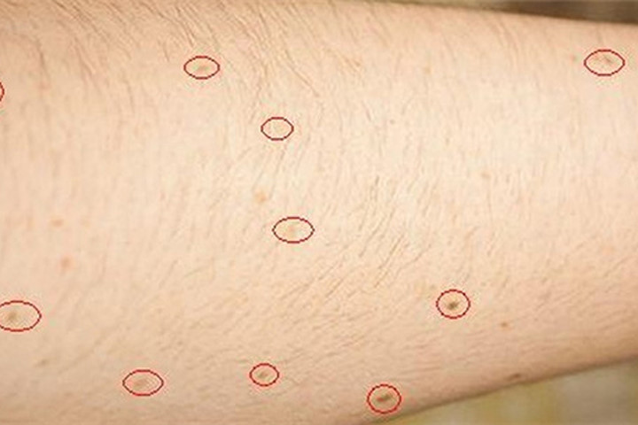 Vì sao nói những người có hơn 11 nốt ruồi trên cánh tay phải là rất đáng lo?