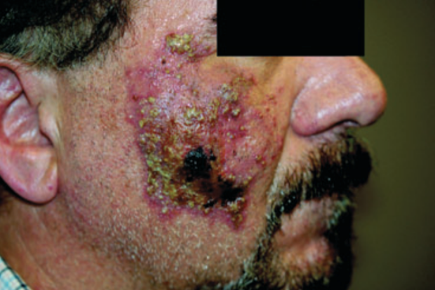 Tiêm chất làm đầy, người phụ nữ bị hoại tử môi nặng đến nỗi rơi cả một mảng thịt ở môi ra ngoài - Ảnh 4.