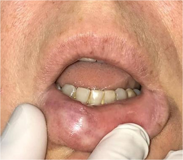 Tiêm chất làm đầy, người phụ nữ bị hoại tử môi nặng đến nỗi rơi cả một mảng thịt ở môi ra ngoài - Ảnh 8.