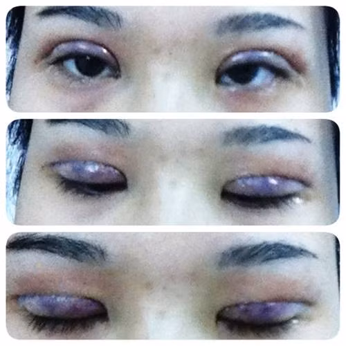 cắt mí, thẩm mĩ, chị em, đổ xô, chơi tết, làm đẹp