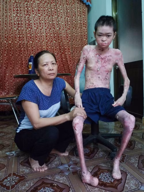 Chàng trai 20 tuổi chỉ nặng 21 kg vì bệnh giống bỏng