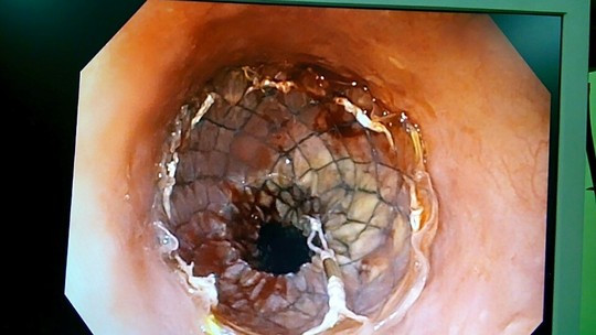 95% biểu hiện khó nuốt là ung thư thực quản. 95% biểu hiện khó nuốt là ung thư thực quản.